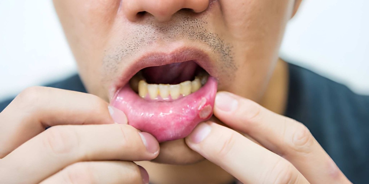 Reframing Care Strategies for Oral Mucositis Management