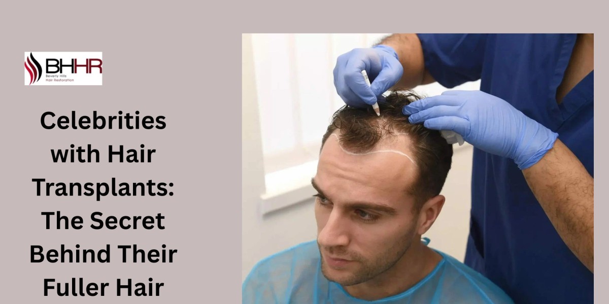 Celebrities with Hair Transplants: The Secret Behind Their Fuller Hair