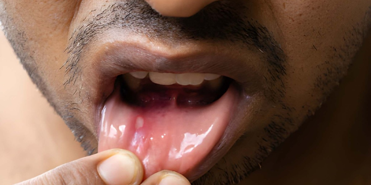 Bridging the Gap in Oral Mucositis Care