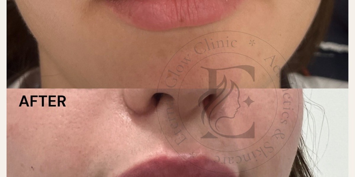 Rejuvenate Your Radiance: The Ultimate Guide to Advanced Aesthetic Treatments in Milton Keynes